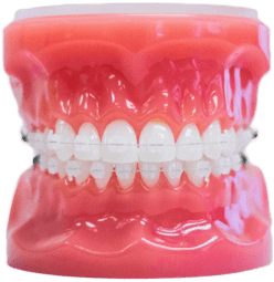 clear braces model